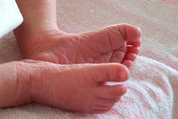 prevenir la dermatitis atópica en bebés pasa por una adecuada
