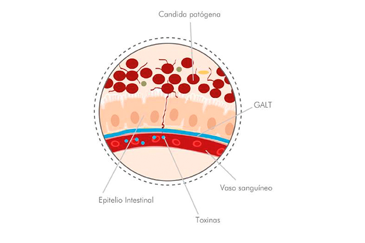 candidiasis-y-cistitis-como-tratar-dos-de-las-patologias-genitourin