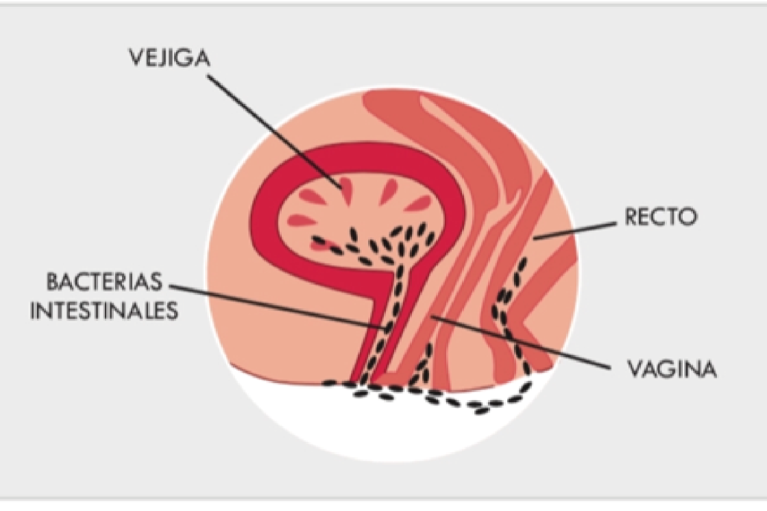 candidiasis-y-cistitis-como-tratar-dos-de-las-patologias-genitourin